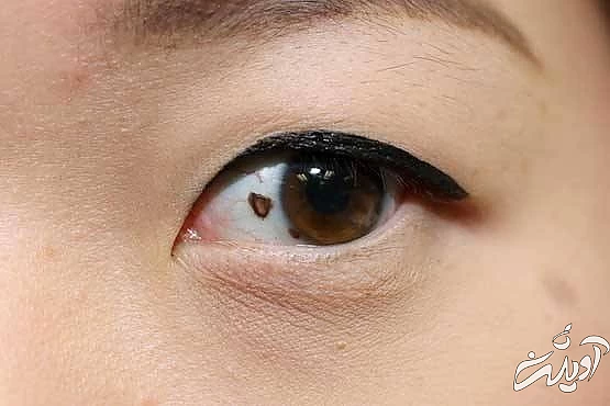 شخصیت شناسی خال در چشم خال در چشم